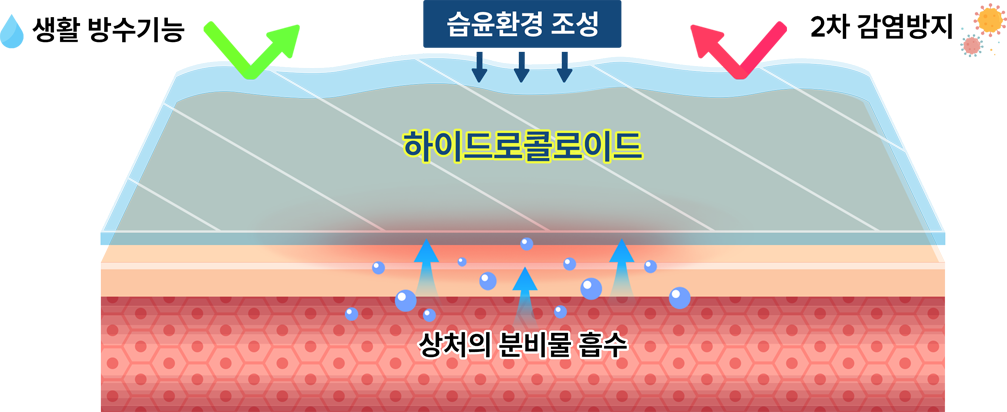 하이드로콜로이드